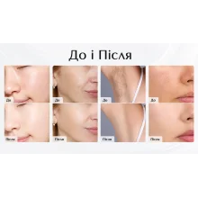 ESTI-60 — професійний косметологічний апарат  для фототерапії, роботи з пігментацією, татуюваннями та омолодження шкіри